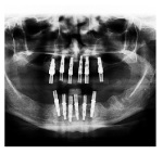 фото верхней челюсти с установленными имплантантами (верх фото) и завершенным протезированием коронками(нижнее фото) 6 имплантов Самара